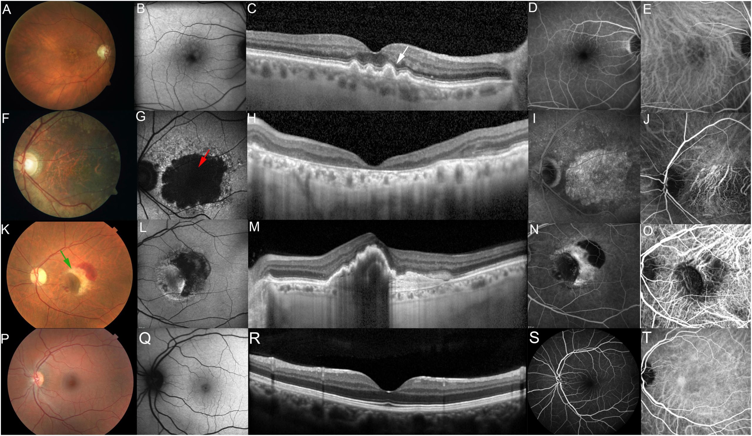 Personalized Approaches to AMD Disease Treatment